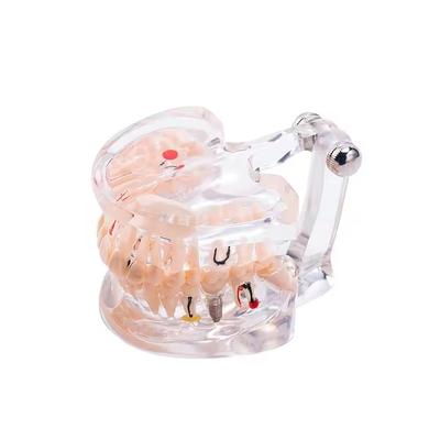 32 Dente Mês Completo Doença do Implante Dentes Modelo Desenho Claro Modelo de Patologia Dental