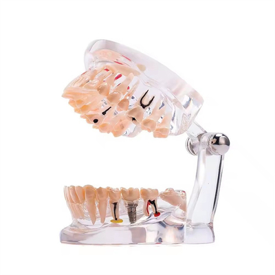 32 Dente Mês Completo Doença do Implante Dentes Modelo Desenho Claro Modelo de Patologia Dental